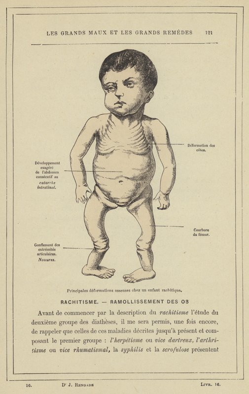 Principales déformations osseuses chez un enfant rachitique - French School