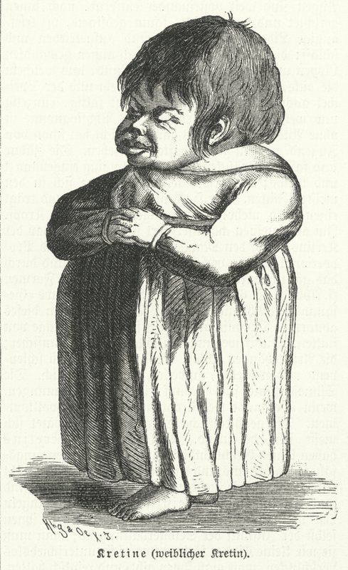 Crétin, femme souffrant de carence congénitale en iode (gravure) - German School