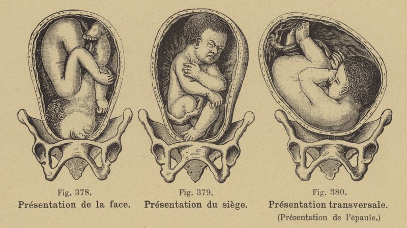 Malprésentation des bébés dans l