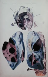 Apoplexie du cœur et des poumons, planche d