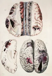 Apoplexie capillaire, de 