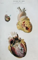 Planche représentant des maladies cardiaques. Rupture spontanée du cœur d