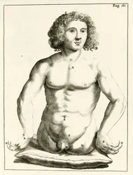 Exemple de malformations congénitales, de Exercitationes Practicae circa Medendi Methodum par Frederik Dekkers, 1694