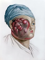 Scrofule cancéreuse, de Description des Maladies de la Peau par Baron Jean Louis Alibert, Paris, 1806