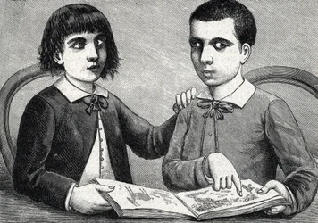 Enfants avec strabisme convergent et divergent ou yeux croisés (gravure) 1888