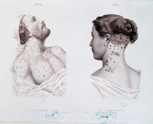 Symptômes de la syphilis chez les hommes et les femmes, tirés d