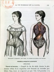 Les effets nocifs du corset, illustration tirée de « La Vie Normale et la Santé » du Dr Jules Rengade (né en 1841), vers 1880