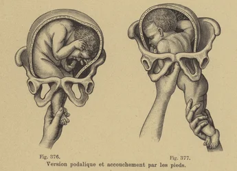 Accouchement d