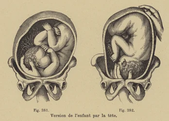 Tourner un bébé dans le ventre de sa mère pour que la tête soit orientée vers le bas avant la naissance