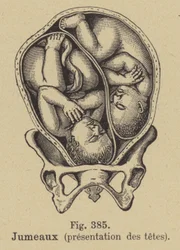 Jumeaux dans le ventre de leur mère
