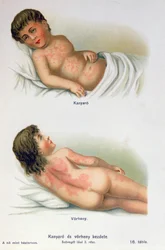 Rougeole et scarlatine, d