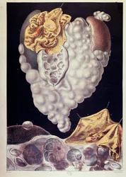 Cancer - de Cruveilhier