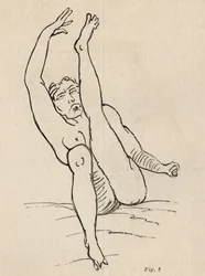 Épilepsie hystérique, attaque, contorsions, fig. 2 de 