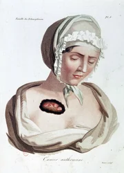 Cancer anthracine - Alibert, B.N.