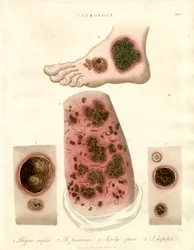 Pathologies cutanées - Pityria, impétigo et syphilis