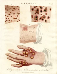 Maladies de la peau : Ecthyma, gale purulente et variole