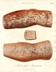 Éruptions cutanées - Roseola simplex et Roseola paristhmitica