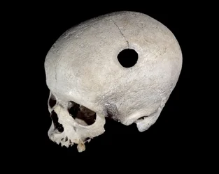 Crâne préhistorique portant une trace de trépanation, Musée des Antiquités nationales
