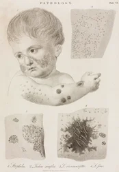 Dermatologie Types de maladies de la peau