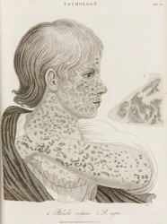 Maladies, rougeole Deux types de rougeole