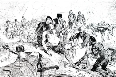 Ambroise Paré ligaturant des artères après amputation