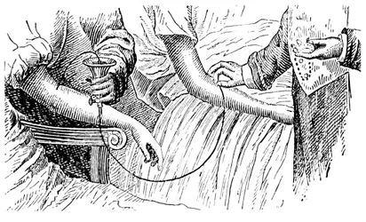 Transfusion sanguine, vers 1880