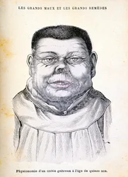 Crétin âgé de 15 ans, vers 1890