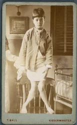 Rachitisme (jambes rachitiques) Enfant avec rachitisme