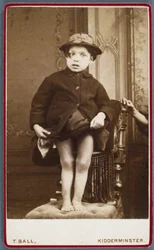 Rachitisme (jambes rachitiques) Enfant avec rachitisme
