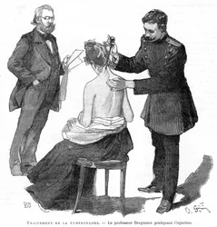Le professeur Bergmann injectant un patient tuberculeux, 1891