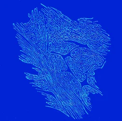 Section transversale de tumeurs fibro-nucléées