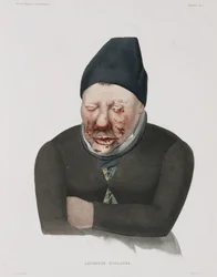 Maladies, Lèpre