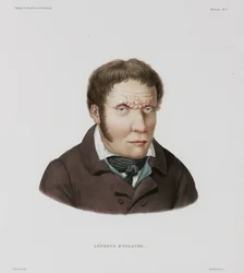 Maladies, Lèpre