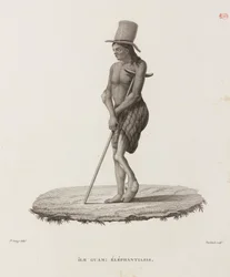 Maladies, maladies tropicales Homme avec éléphantiasis, Guam