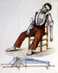 Patient atteint de choléra