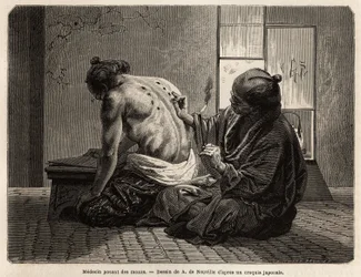 Un médecin posant des moxas (petits cônes d