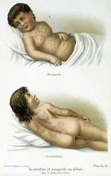 Scarlatine et rougeole - XIXe siècle
