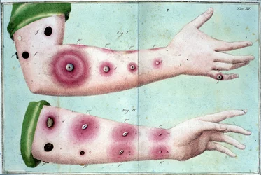 Symptômes de la variole provoquant une éruption de pustules sur la peau. Planche médicale tirée du «Traité de la vaccination» de Luigi Sacco, Milan