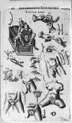 Interventions chirurgicales sur les sexes féminin et masculin. Gravure dans « Armamentarium Chirurgical » par J. Scultetus, Venise