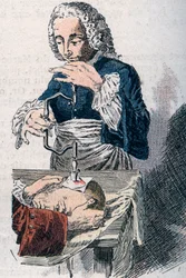La trépanation. Estampe du XVIIIe siècle.
