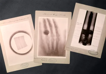Radiographies originales de Roentgen (radiographie)